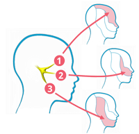 Cefaleas: la neuralgia del trigémino puede afectar a la zona frontal, maxilar y mandibular