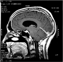 Investigación en cefalea: Resonancia Magnética y Neuroimagen